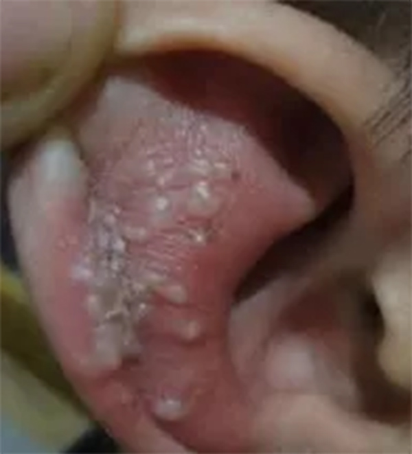 耳带状疱疹
