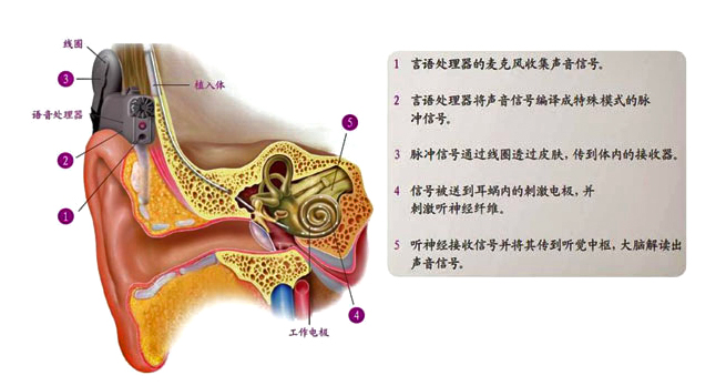 人工耳蜗的工作原理