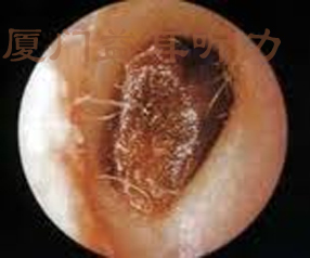 耵聍栓塞吸引器图片
