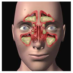 鼻炎3d结构图图片