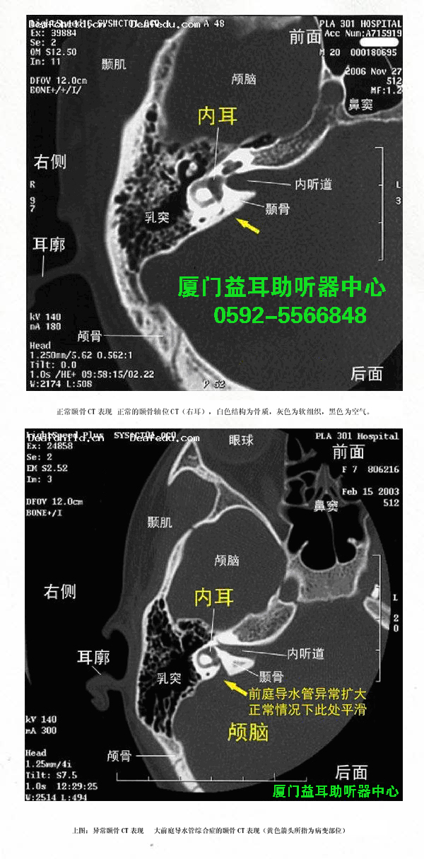 大前庭导水管综合症的识别
