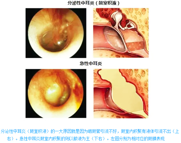 分泌性中耳炎与急性中耳炎图解