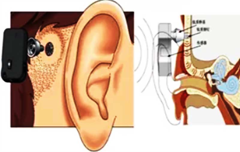 骨桥助听器植入图片
